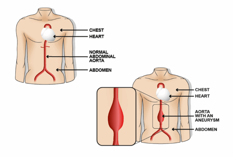 Abdominal Aortic Aneurysm (AAA) Screening service - University ...