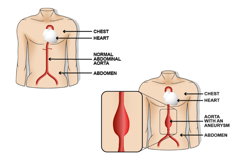 Diagram that shows an 'Abdominal Aortic Aneurysm' 